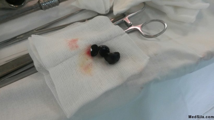 Камни извлеченные из желчных протоков пациента.